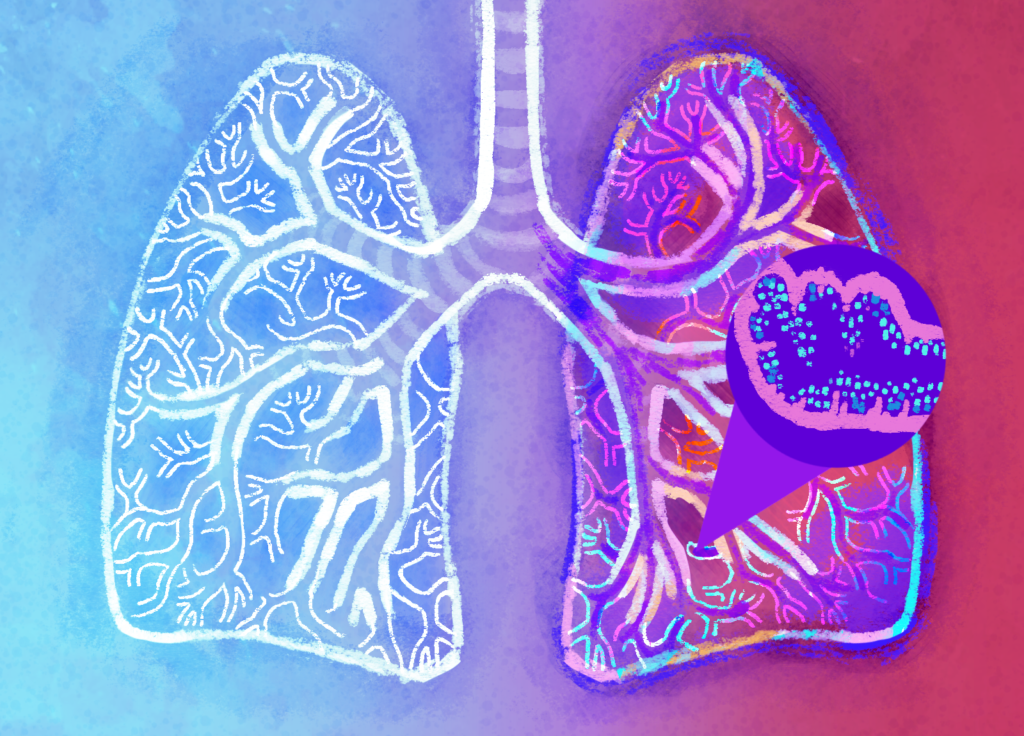 cystic fibrosis lung sounds